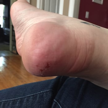 Sky Nails - Picture of the injury I received on my heal - Nail Technicians Near Me - Saint Cloud, Minnesota