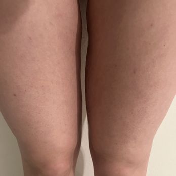 Vitality Medical Center - Indentation after lipo on left leg, more noticeable in person - Medical Spas Near Me - Glendale, California