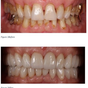 Ann Wei, DDS FACP - full mouth rehabilitation due to severe erosion - General Dentistry Near Me - San Francisco, California Ann Wei, DDS FACP - full mouth rehabilitation due to severe erosion - General Dentistry Near Me - San Francisco, California