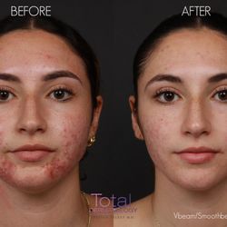 Total Dermatology - Patient was treated with a combination of Vbeam and Smoothbeam lasers, as well as LightStim LED therapy for acne.