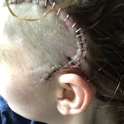 Lonestar Medical - Weeks later, they wouldn't take out of my head. Took 5 minutes & wasn't a huge biohazard, just no extra money in it for them.