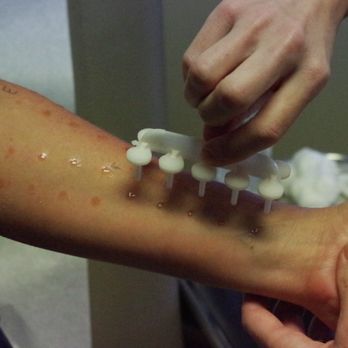 Aspire Allergy & Sinus - Northwest - Allergy test being performed on arm. - Allergists Near Me - Tucson, Arizona Aspire Allergy & Sinus - Northwest - Allergy test being performed on arm. - Allergists Near Me - Tucson, Arizona