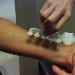 Aspire Allergy & Sinus - Northwest - Allergy test being performed on arm.
