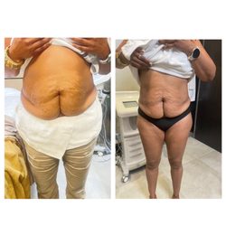 Beauty Loft Spa - Meso therapy for fat dissolve