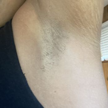 Dulce Lash & Skin Lounge- Bellevue - Left armpit after 3rd session. - Eyelash Service Near Me - Bellevue, Washington Dulce Lash & Skin Lounge- Bellevue - Left armpit after 3rd session. - Eyelash Service Near Me - Bellevue, Washington