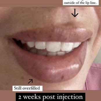 DNAge Medical - Dr.Dulce Botched Lips - Medical Spas Near Me - Miami, Florida