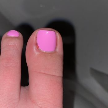 Botanix Nail Spa - Infected toe nail - Nail Salons Near Me - Newark, Delaware Botanix Nail Spa - Infected toe nail - Nail Salons Near Me - Newark, Delaware