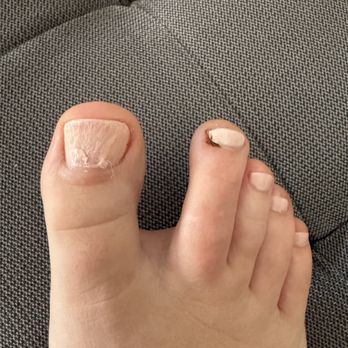 Blossom Nails and Spa - Bloody toe and hurt for two weeks! - Nail Salons Near Me - Troy, Michigan Blossom Nails and Spa - Bloody toe and hurt for two weeks! - Nail Salons Near Me - Troy, Michigan