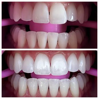 Vivid Teeth Whitening - Teeth Whitening Near Me - Petaluma, California Vivid Teeth Whitening - Teeth Whitening Near Me - Petaluma, California