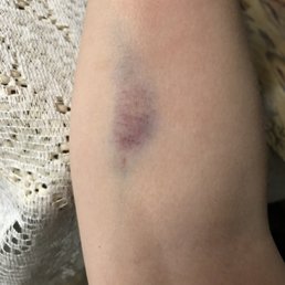 Bruised messed up vein! Hurt and probably damaged! All she said was "it's okay just put some ice on it!" Bruised messed up vein! Hurt and probably damaged! All she said was "it's okay just put some ice on it!"