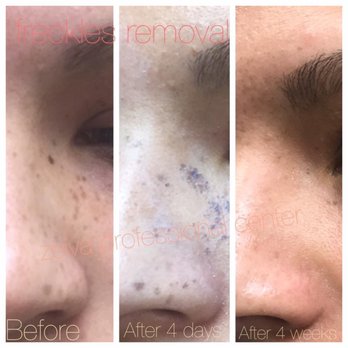 Zeiva Professional Center - Freckles removal - Skin Care Near Me - Dearborn, Michigan Zeiva Professional Center - Freckles removal - Skin Care Near Me - Dearborn, Michigan