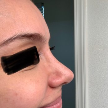 Vladimir Grigoryants, MD - Tip over-projected. Not happy with results. - Cosmetic Surgeons Near Me - Glendale, California Vladimir Grigoryants, MD - Tip over-projected. Not happy with results. - Cosmetic Surgeons Near Me - Glendale, California