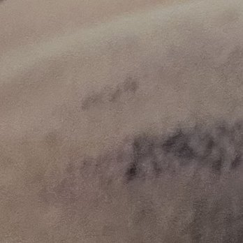 Kalologie Medspa Austin - This is the laser hair removal that I got from Kalologies Med Spa. - Skin Care Near Me - Austin, Texas