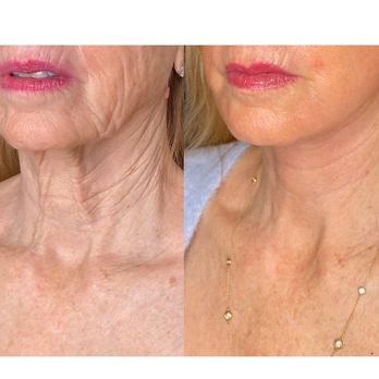 PERK Plastic Surgery - Facelift with fat grafting and laser skin resurfacing - Cosmetic Surgeons Near Me - Beverly Hills, California PERK Plastic Surgery - Facelift with fat grafting and laser skin resurfacing - Cosmetic Surgeons Near Me - Beverly Hills, California