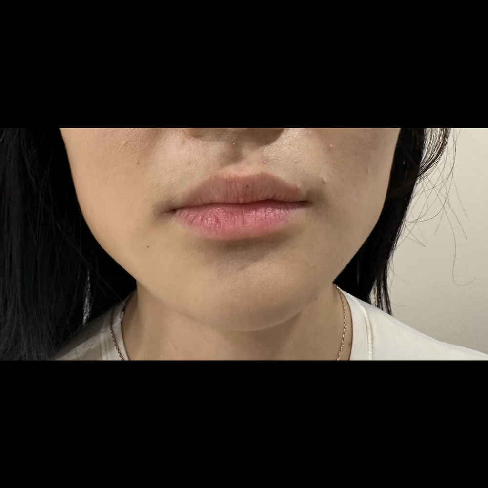 Dermaster - Before - Skin Care Near Me - Los Angeles, California Dermaster - Before - Skin Care Near Me - Los Angeles, California