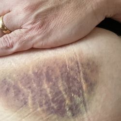 MultiCare Covington Emergency Department - Mystery bruise that was not there at time of admission.