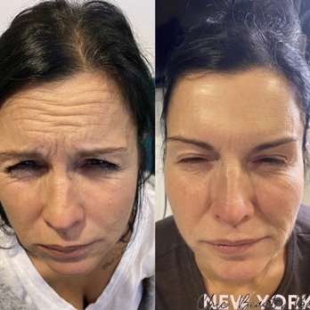 Chic Beauty Bar - Full Botox treatment (Forehead, Glabella & Crows feet) - Eyebrow Services Near Me - Edgewater, New Jersey Chic Beauty Bar - Full Botox treatment (Forehead, Glabella & Crows feet) - Eyebrow Services Near Me - Edgewater, New Jersey