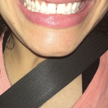 Bella Smiles - Not only is my teeth not even whitened after an expensive deep laser cleaning PLUS whitening, but my lip is STILL swollen and gums - Cosmetic Dentists Near Me - Las Vegas, Nevada Bella Smiles - Not only is my teeth not even whitened after an expensive deep laser cleaning PLUS whitening, but my lip is STILL swollen and gums - Cosmetic Dentists Near Me - Las Vegas, Nevada