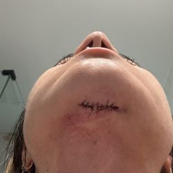 Second surgery after failed first attempt.