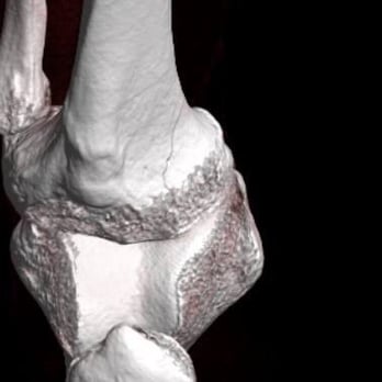 Mountain Medical Imaging Center - Slight fracture on the inside of the Tibia Plateau. - Diagnostic Imaging Near Me - Murray, Utah Mountain Medical Imaging Center - Slight fracture on the inside of the Tibia Plateau. - Diagnostic Imaging Near Me - Murray, Utah