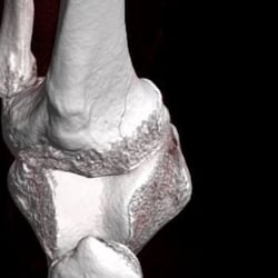 Mountain Medical Imaging Center - Slight fracture on the inside of the Tibia Plateau.