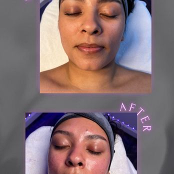 Holistic Esthetics & Restorative Care - Before and after - Skin Care Near Me Holistic Esthetics & Restorative Care - Before and after - Skin Care Near Me