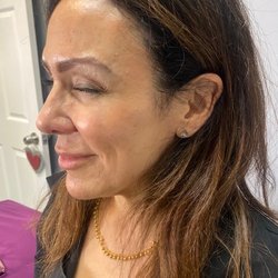 Derm Perfect The Elites' Medspa - 2 weeks after Injections of crow's feet
