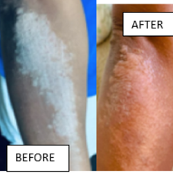 Shobha Vasa, BHMS, RSHom - DFW Homeopath - Before and After Treatment