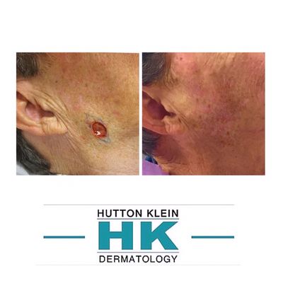 Mohs Skin Cancer Surgery - Mohs surgery is a highly effective skin cancer treatment that involves progressive removal of very thin layers of cancerous skin. Mohs surgery is a meticulous technique that ensures no cancer cells remain.
During Mohs surgery, your doctor removes one fine layer of tissue at a time and examines it under a microscope to check for cancer cells. Mohs Surgery allows the surgeon to control the size and depth of the surgery by carefully examining all edges of the tissue. The Mohs micrographic surgery approach eliminates the need to estimate how deeply the cancer is rooted in the skin.
Once they confirm that no cancer cells remain, your doctor stops removing skin. This allows as much healthy tissue to remain as possible while also completely removing the skin cancer.
At HK Dermatology, the Mohs wound is usually closed the day of the procedure with beautiful cosmetic results. Mohs Skin Cancer Surgery - Mohs surgery is a highly effective skin cancer treatment that involves progressive removal of very thin layers of cancerous skin. Mohs surgery is a meticulous technique that ensures no cancer cells remain.
During Mohs surgery, your doctor removes one fine layer of tissue at a time and examines it under a microscope to check for cancer cells. Mohs Surgery allows the surgeon to control the size and depth of the surgery by carefully examining all edges of the tissue. The Mohs micrographic surgery approach eliminates the need to estimate how deeply the cancer is rooted in the skin.
Once they confirm that no cancer cells remain, your doctor stops removing skin. This allows as much healthy tissue to remain as possible while also completely removing the skin cancer.
At HK Dermatology, the Mohs wound is usually closed the day of the procedure with beautiful cosmetic results.