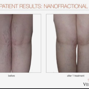 Tada Skin Spa - Stretch mark reduction with the Venus Viva Nanofractional Treatment - Laser Hair Removal Near Me - Houston, Texas
