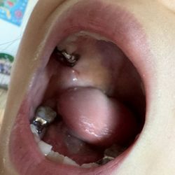 Spitz & Davis Pediatric Dentistry - My daughter got three tooth infections in a few months after the three fillings were done at Dr. Spitz and Davis.