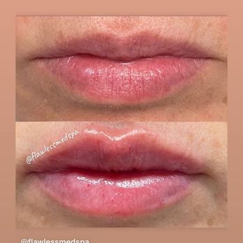 Flawless MedSpa - Juvederm lip filler! - Medical Spas Near Me - Burlington, Massachusetts Flawless MedSpa - Juvederm lip filler! - Medical Spas Near Me - Burlington, Massachusetts