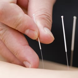 Ask our doctor for acupuncture