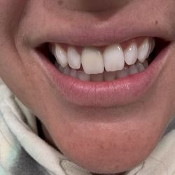 Aspire Dental - The only one that doesn't match the rest of my white teeth. It's embarrassing as it's the very front one.