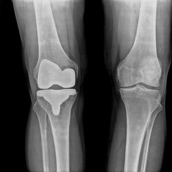 Bergman Family Chiropractic - My right knee had 2 failed knee replacement, now docs want to wreck the left one too