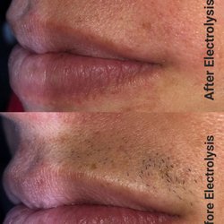 Purely Bare Electrolysis - Upper lip cleared in one session!