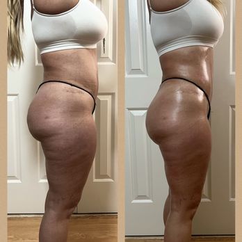 BodySculpt305 - Body Contouring Near Me BodySculpt305 - Body Contouring Near Me