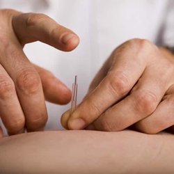 MABRA Acupuncture Clinic - Acupuncture
