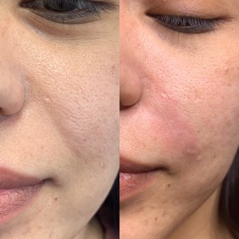 MedSkinEssentials - Before/After Filler for volume replacement in nasolabial folds/smile lines *immediately post procedure- swelling present* - Medical Spas Near Me - Tustin, California MedSkinEssentials - Before/After Filler for volume replacement in nasolabial folds/smile lines *immediately post procedure- swelling present* - Medical Spas Near Me - Tustin, California