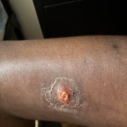 St Johns Episcopal Hospital - Three staphylococcus infections UNDER RIGHT CALF