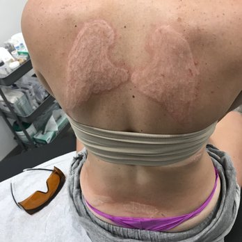 Progress MD - Right after treatment - Medical Spas Near Me - Amarillo, Texas