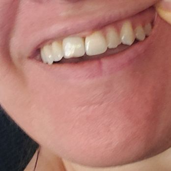 Monica Crooks, DDS - Before smile makeover... - Cosmetic Dentists Near Me - Sacramento, California Monica Crooks, DDS - Before smile makeover... - Cosmetic Dentists Near Me - Sacramento, California