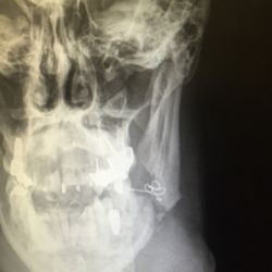 Listiyo Family Dental - Left mandible displaced Fracture from a dentist using a metal tool to clean a gap from a tooth extraction