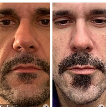 Elysian Aesthetics & Wellness - Before and after laugh line fillers - Medical Spas Near Me - Charlotte, North Carolina Elysian Aesthetics & Wellness - Before and after laugh line fillers - Medical Spas Near Me - Charlotte, North Carolina