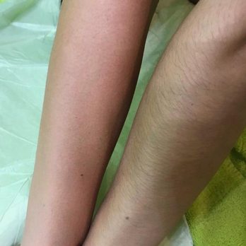 Alda Laser Spa - Before the first treatment and right after one! - Laser Hair Removal Near Me - Brooklyn, New York