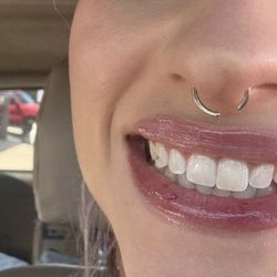 Los Angeles Dentist - Studio Smiles - Before