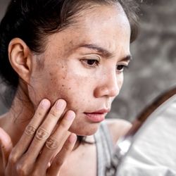 Medical Laser & Aesthetics - We treat Age spots, freckles and Melasma.