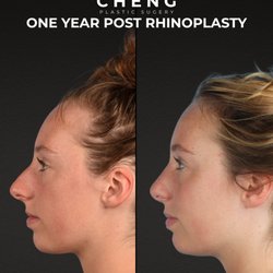 Cheng Plastic Surgery - 1 Year Post Rhinoplasty