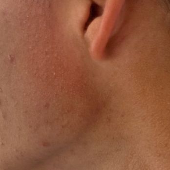 14 West - My son allergic reaction from sleeping in the hotel bed - Hotels Near Me - Laguna Beach, California 14 West - My son allergic reaction from sleeping in the hotel bed - Hotels Near Me - Laguna Beach, California