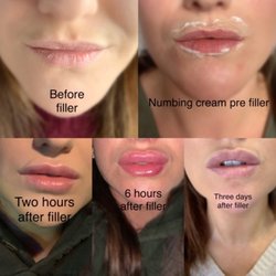 The Spa Clinic - The most painful time for recovery has been hour 6 after the filler, this is normal for fillers and swelling goes down!